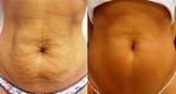 Images of Laser Treatment Loose Skin After Pregnancy