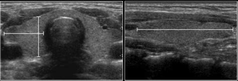 The Radiology Assistant Normal Values Ultrasound