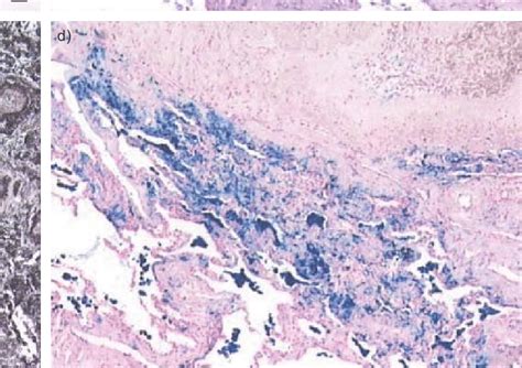 Histological Staining Of Lung Biopsy In Pulmonary Veno Occlusive