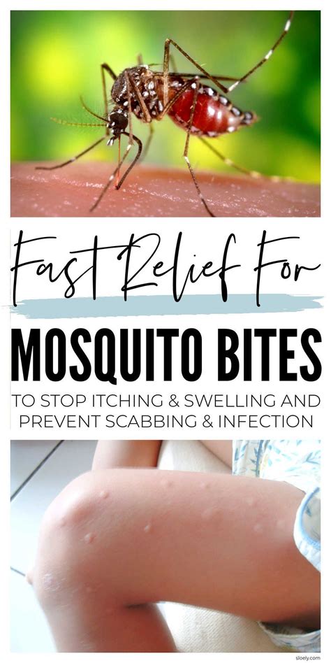 Diy Mosquito Bite Remedies In 2022 Remedies For Mosquito Bites