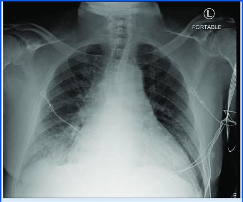 Case 1 Initial Chest X Ray With Cardiomegaly Pulmonary Venous