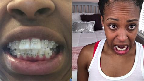 Adult Braces 1 Year Update Before And After Pics Youtube