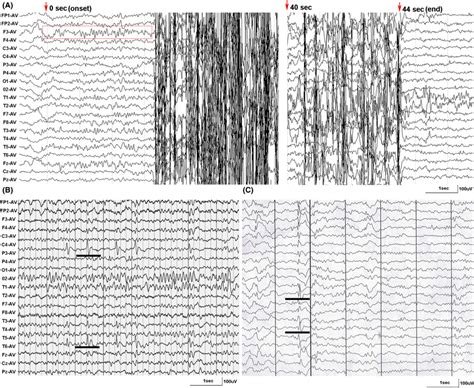 Ictal And Interictal Eeg In The Cases With Brwd3 Variants A Eeg Of