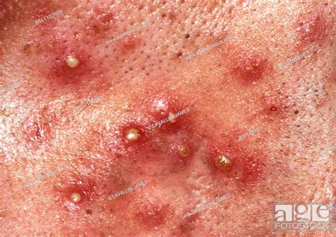 acne acne vulgaris an inflammatory skin disease characterized by lesions of the pilosebaceous