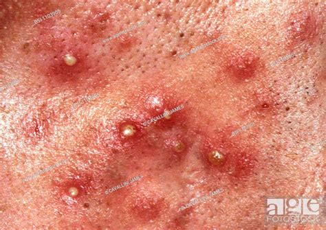 Acne Acne Vulgaris An Inflammatory Skin Disease Characterized By