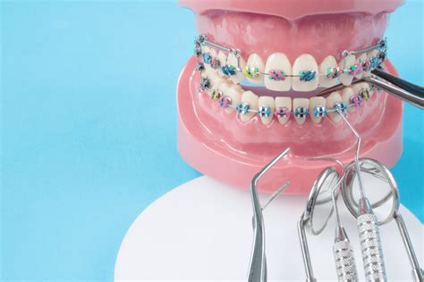 What To Do If Your Braces Have Broken Healthicu