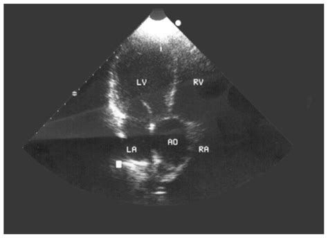 Parasternal View Of Echocardiography Showing Aortic Root Dilatation