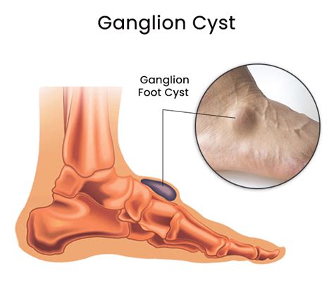 What Causes A Ganglion Cyst On Your Foot And Ankle Premier Podiatry