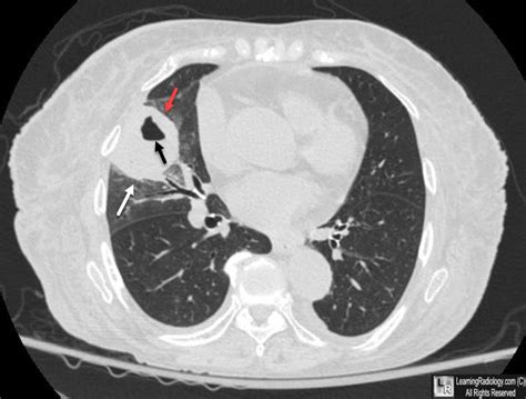 Diagnostic Imaging Of Lung Abscess Lung Abscess And Necrotizing
