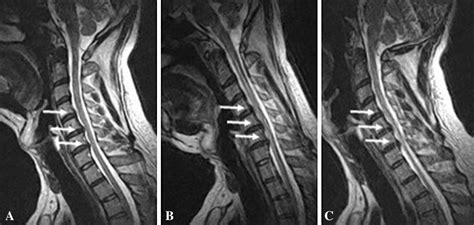 Cervical Disc Herniation MRI