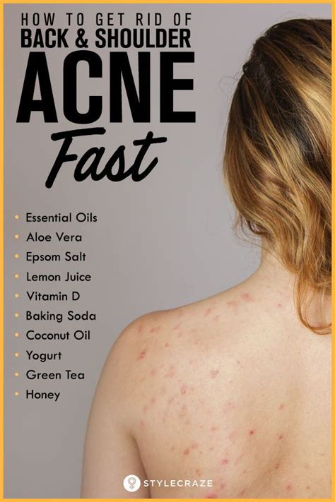 How To Get Rid Of Back Acne Using Home Remedies Shoulder Acne Back