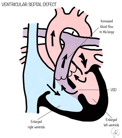 ventricular septal defect vsd scts hot sex picture