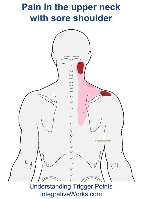 Upper Neck Pain With Sore Top Of Shoulder Neck Pain Neck And Shoulder