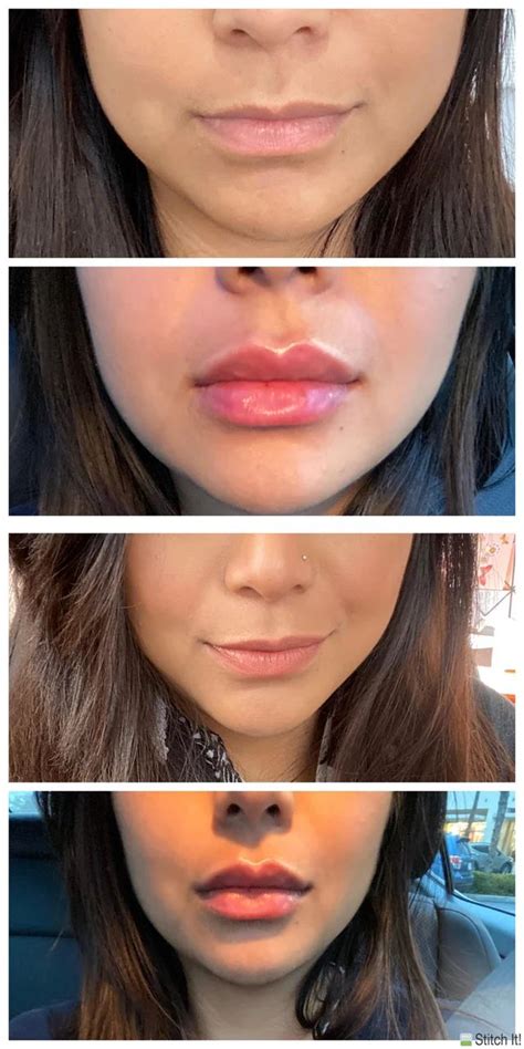 got lip filler today pic of lips before and immediately after 1 syringe of juvederm ultra xc