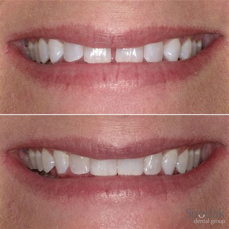 Invisalign Before And After Invisalign Dentist Life Changes