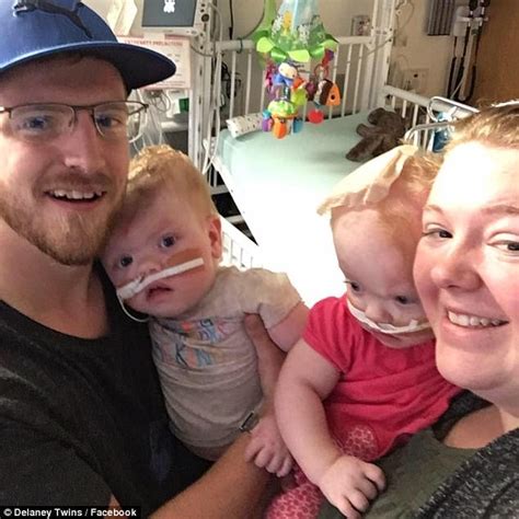 Formerly Conjoined Twins Thriving Five Months After