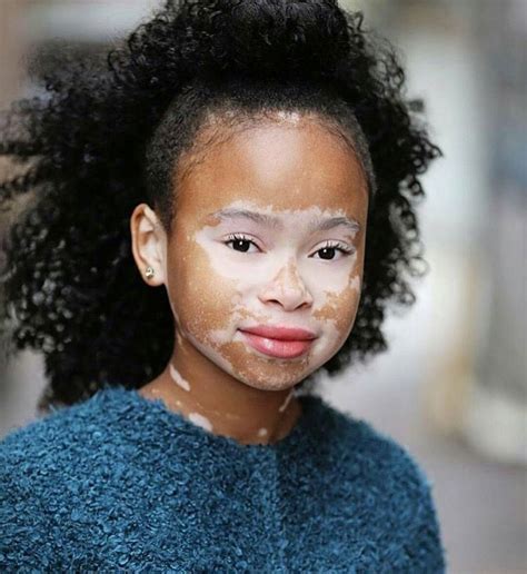 Vitiligo Is A Chronic Skin Condition Characterized By Portions Of The