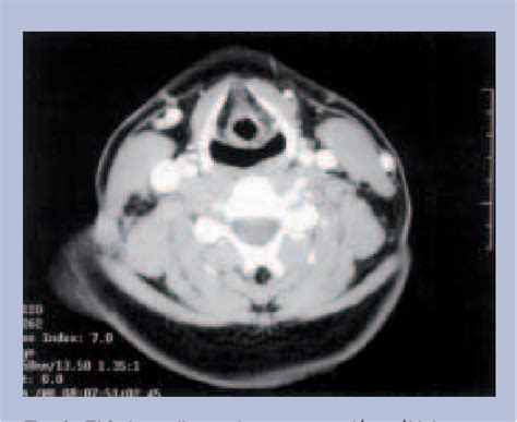 Figure 1 From Linfadenitis Cervical Primaria Fistulizada De Etiología