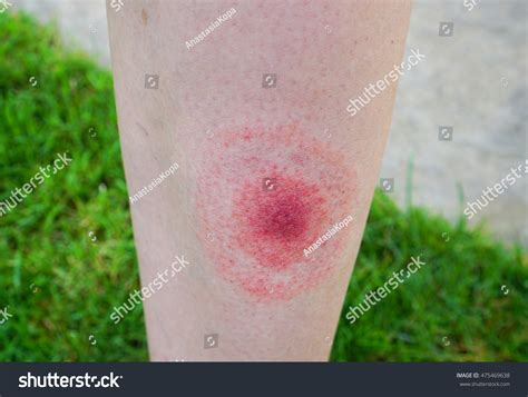 Lyme Disease Rash Images Stock Photos And Vectors Shutterstock