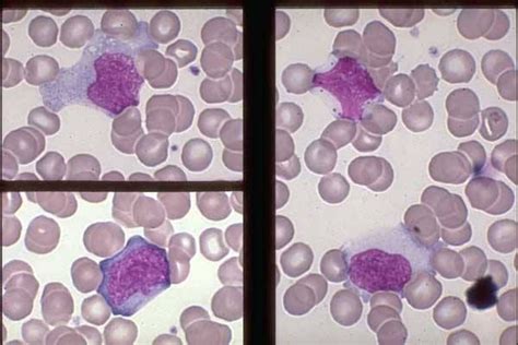 Differentiating Monocytes From Large Lymphocytes Medical Laboratory