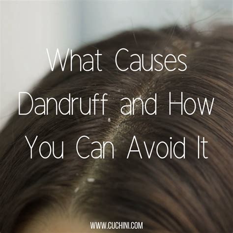 What Causes Dandruff And How Can You Avoid It Cuchini Blog