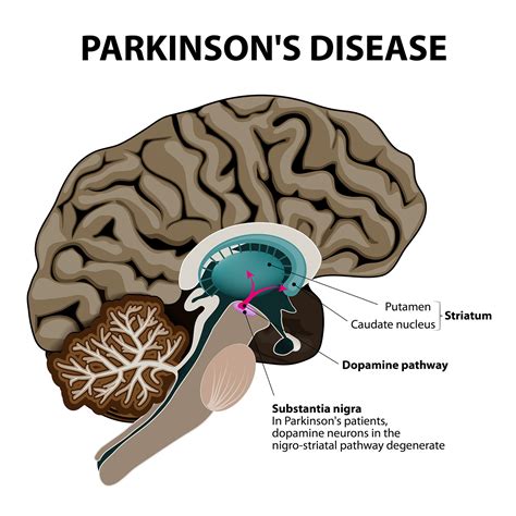Cannabis And Parkinsons Disease
