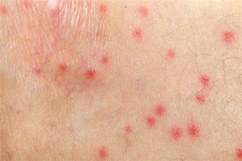 Mosquito Allergy On Human Skin Stock Photo Image Of Epidermis