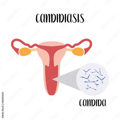 Vaginal Thrush Candidiasis Vaginal Infection Funny Cartoon Style The