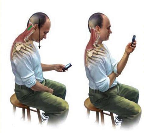 Waspada Text Neck Syndrome Berawal Dari Smartphone Hm Fisioterapi