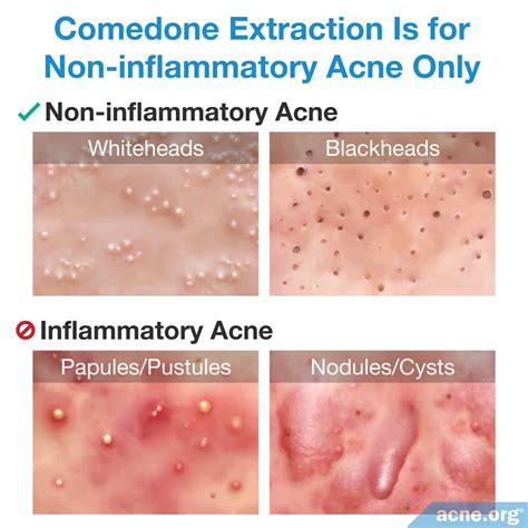 Over production of sebum can cause the pores to become plugged with sebum an. What Is Comedone Extraction, and Should You Do It? - Acne.org