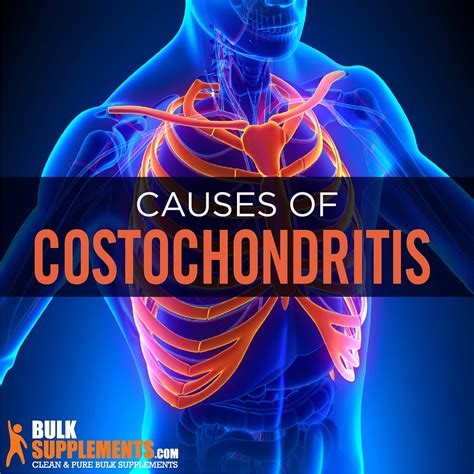 Costochondritis Causes Symptoms And Treatment By Owen Jones Medium