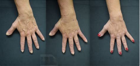 Bulging Hand Veins Permanently Removed With ‘rejuvahands Tm Procedure