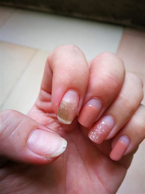 Nail Fungus From Acrylic Nails Cause Treatment And Prevention