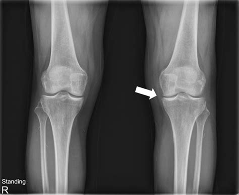 Radiologic Image Showing Mild Joint Space Narrowing On Left Knee Joint