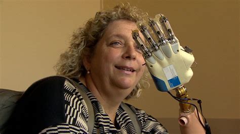 Woman Receives Bionic Hand With Sense Of Touch Sense Of Touch Bionic