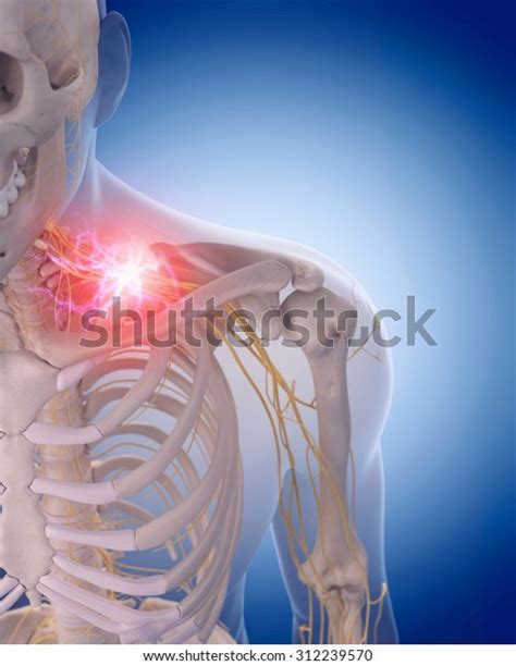 Medically Accurate Illustration Painful Cervical Nerves Stock