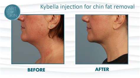 Kybella By Kythera Injection Fat Removal From Chin Youtube