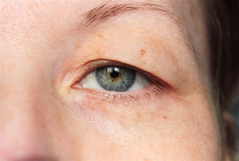 Eyelid Disorders Medlineplus