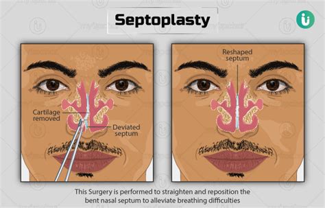 Septoplasty Procedure Purpose Results Cost Price