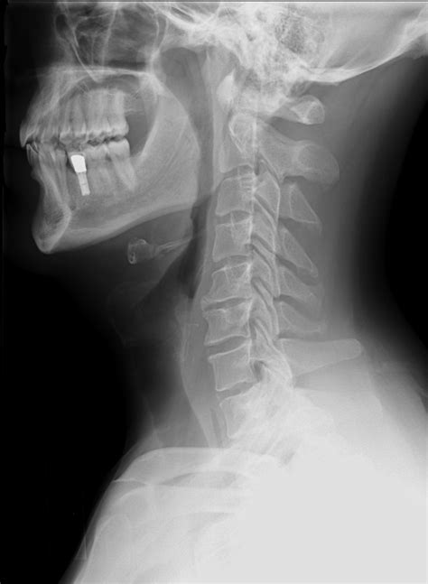 Filecervical Xray Lateral View