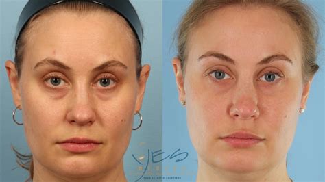Patient Before And After Tear Trough Fillers