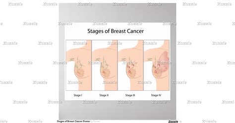 Stagesofbreastcancerposter R3a499288c0f946a9be4536df86446994ozg5