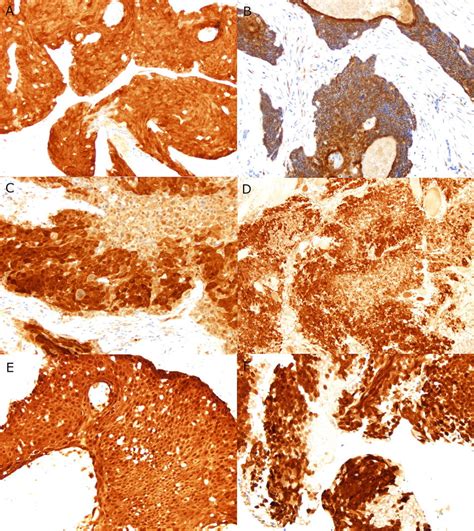 P16 Immunohistochemistry Slides At The First Time 0 And Later Time