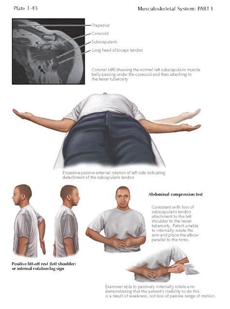 Diagnosis Of Subscapularis Rotator Cuff Tears Subscapularis Tears Can