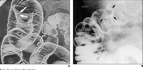 Figure 1 From Double Contrast Barium Enema For Colorectal Cancer