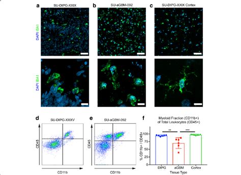 Dipg brain tumour is an aggressive form of childhood brain cancer. DIPG and aGBM tumor-associated microglia/macrophages (a-c ...