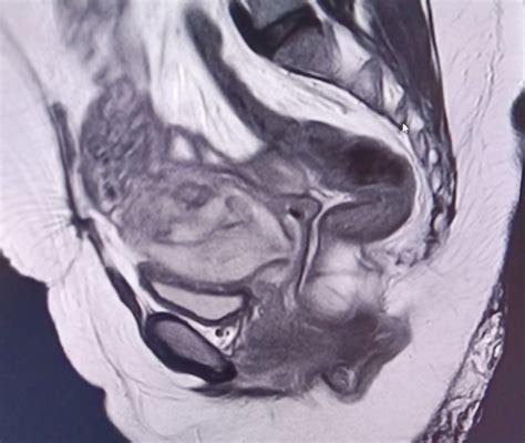 Cesarean Scar Ectopic Pregnancy Mri Sumer S Radiology Blog