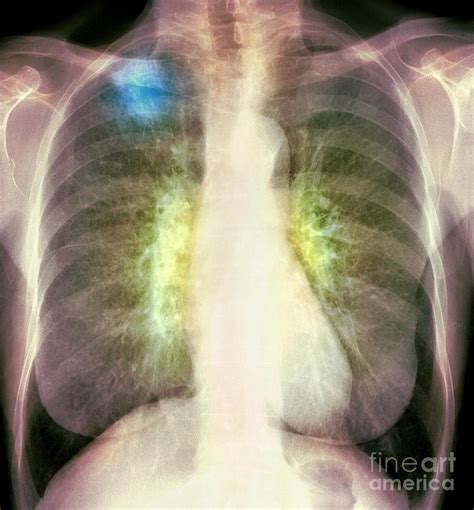 lung cancer x ray photograph by du cane medical imaging ltd