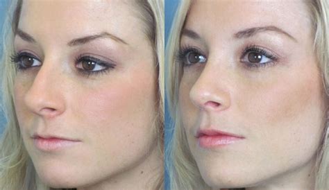 24649 9 guild road, parktown west, netcare millpark hospital, johannesburg, 2193. Best Rhinoplasty