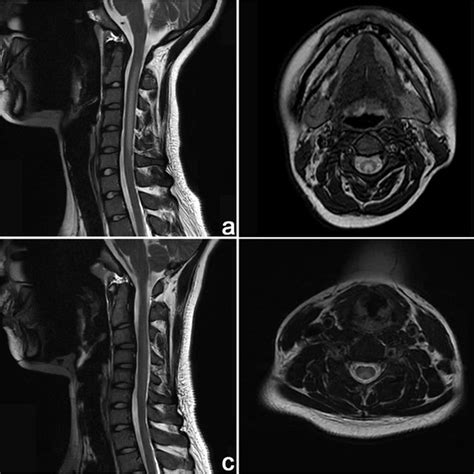 Brain Mri Findings Of The Two Patients Axial T2 Weighted Imaging And